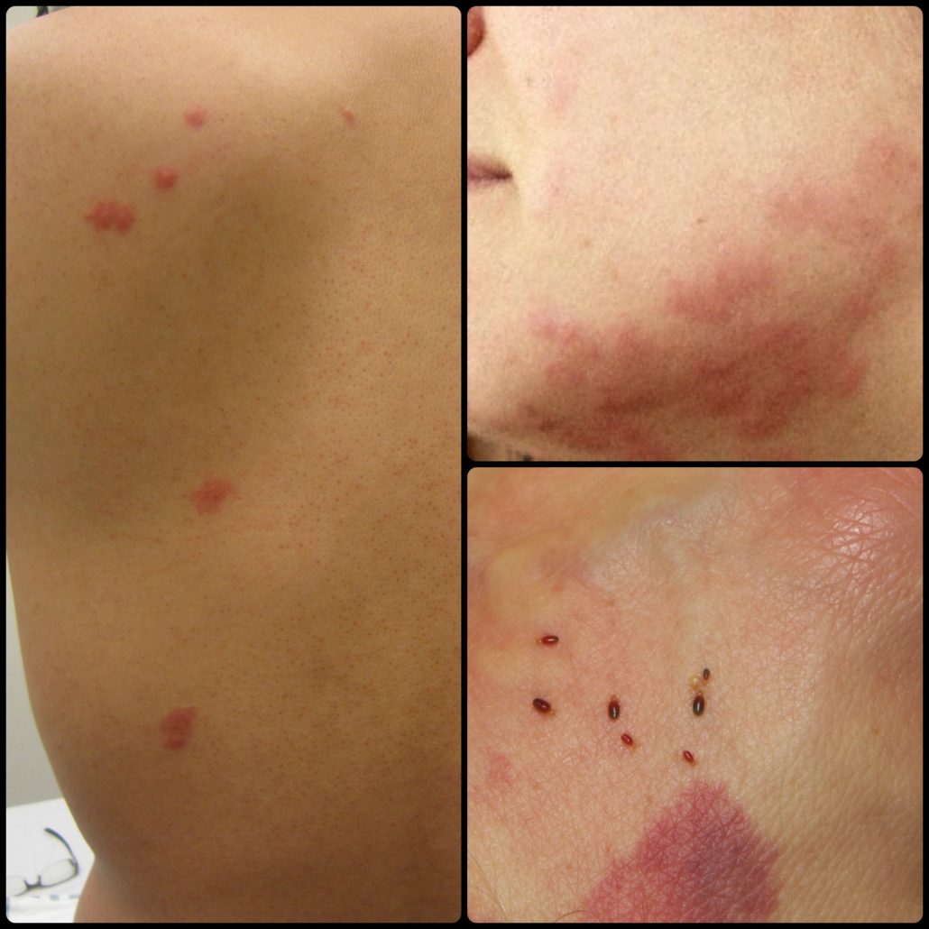 Chagas disease Archives The Bug Guy Pest Control OKC